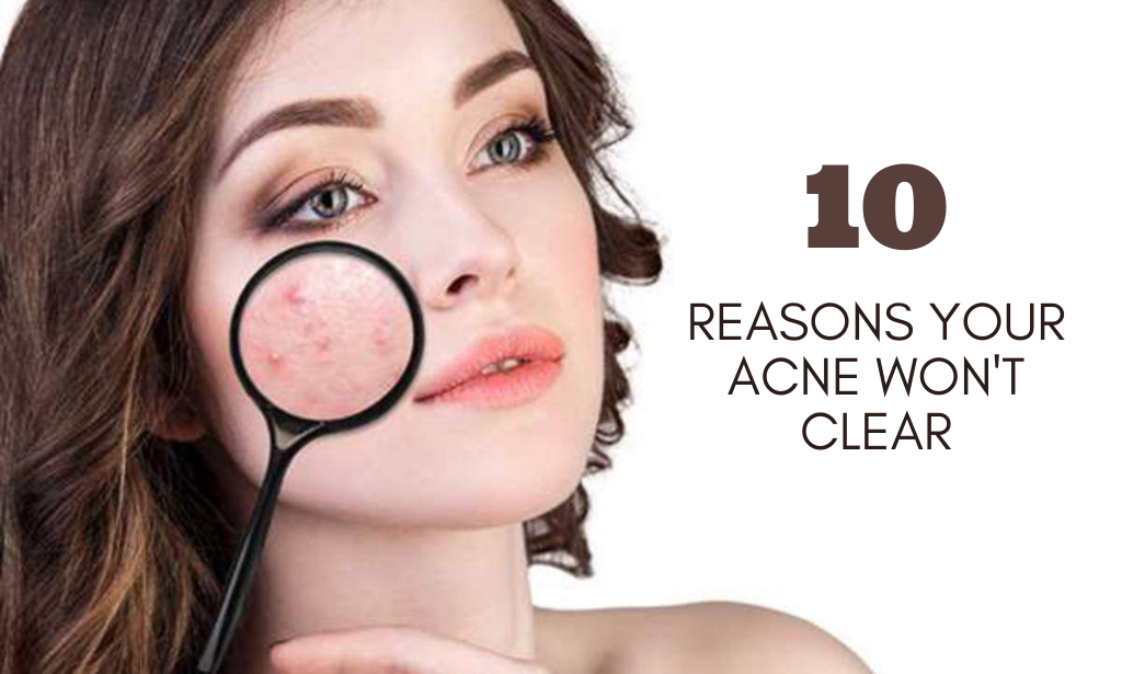 10 Things To Try When Acne doesn't Clear