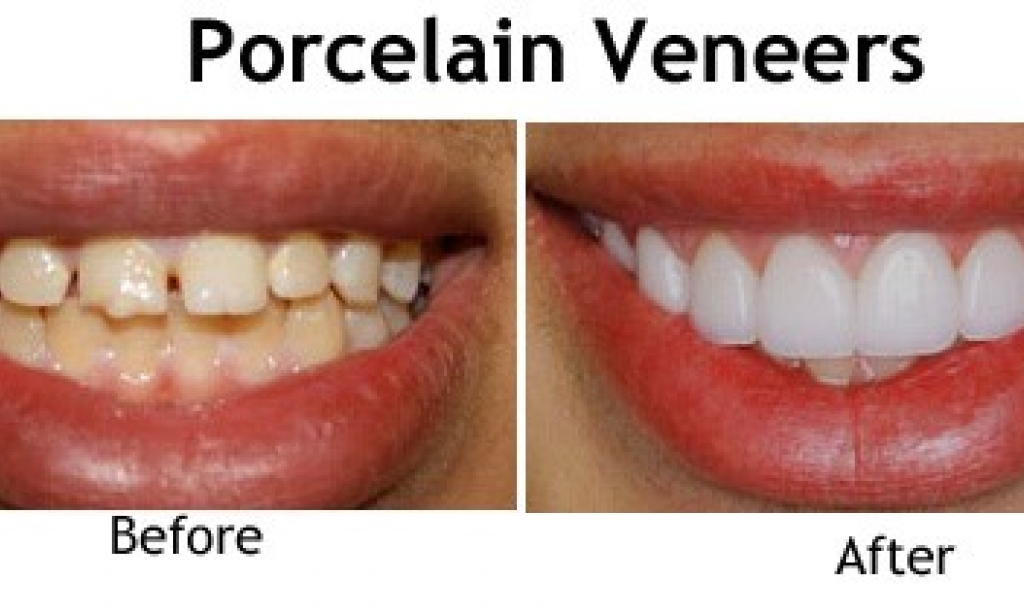 Things to Consider Before Getting Veneers on Your Teeth